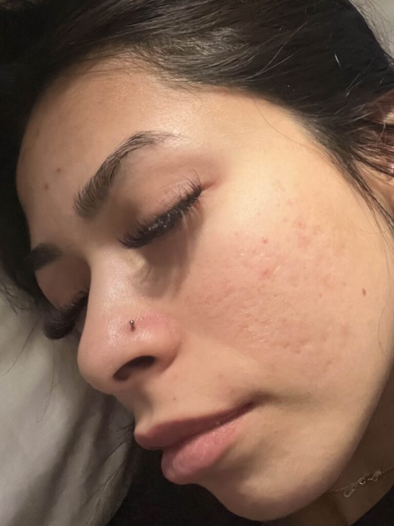 acne facial after