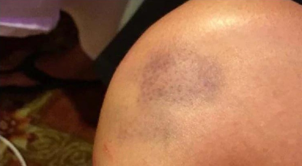 Bruise after one 30 minute Celluma treatment after 2