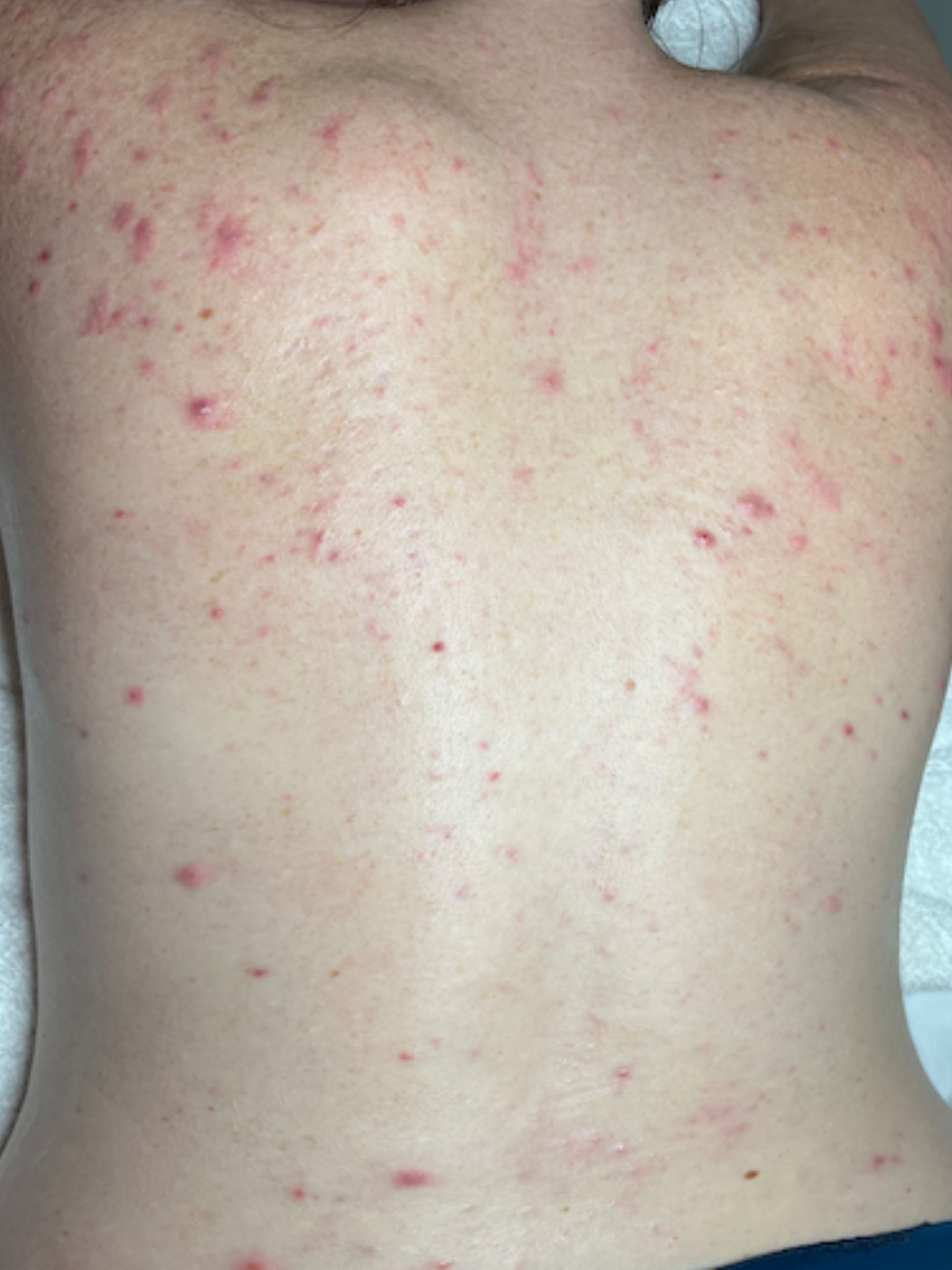 back acne before